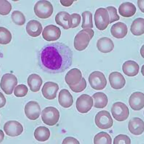 Hairy Cell Leukemia Component